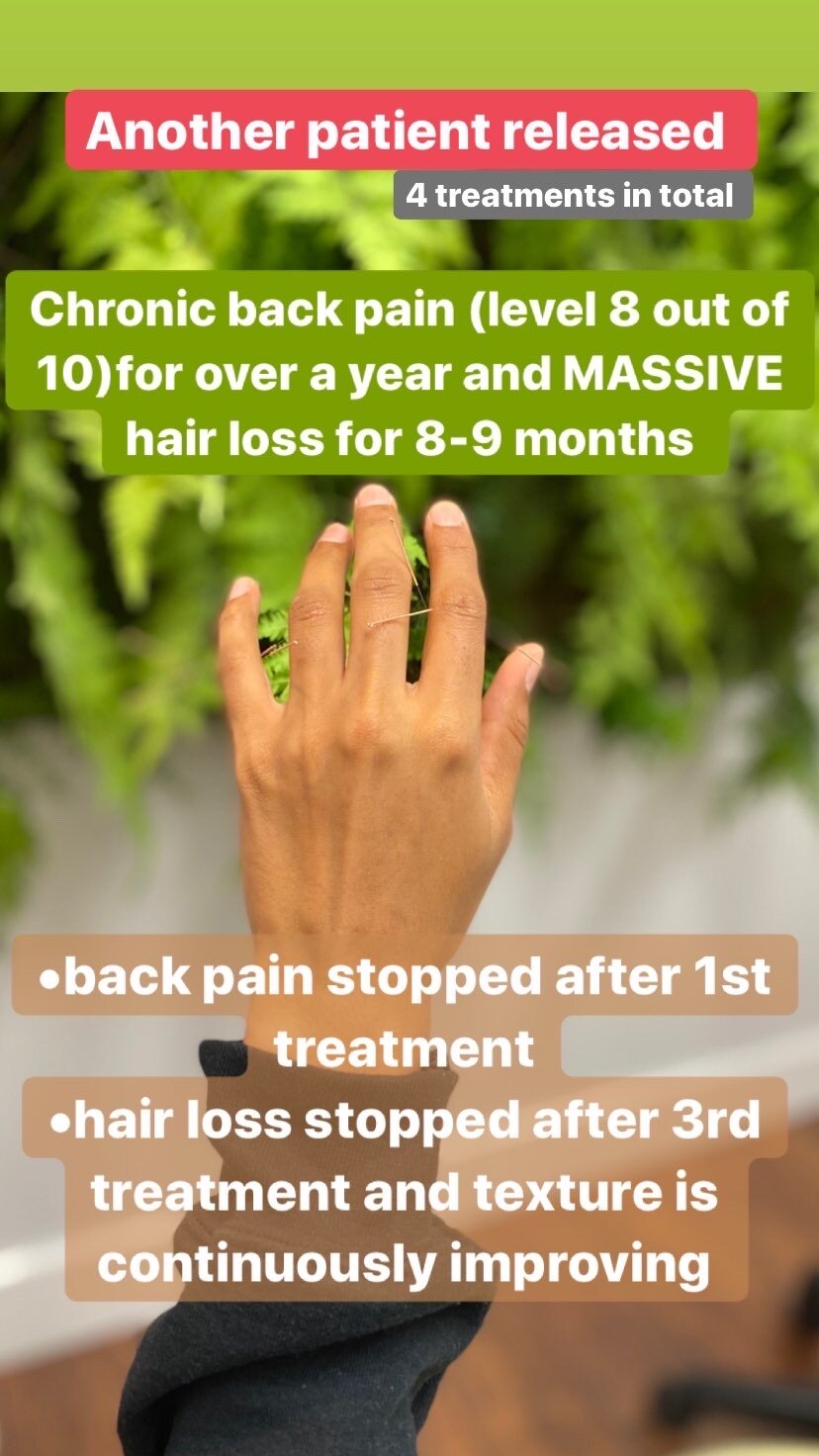  SuJok acupuncture based in vancouver at alla ozerova acupuncture clinic used to treat pain syndrome. Patient suffered from lower back pain and massive hair loss. After first treatment patient stopped feeling back pain and hair loss stopped after 3rd
