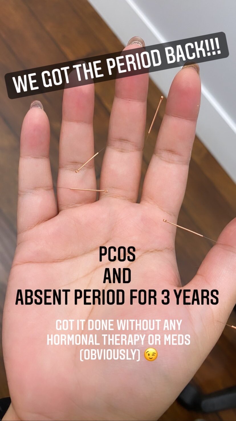  SuJok acupuncture treatment based in Vancouver Canada at Alla Ozerova Acupuncture Clinic used to treat patient with absent period for 3 years and PCOS.  Period came back after acupuncture treatment with no medication or hormones.  