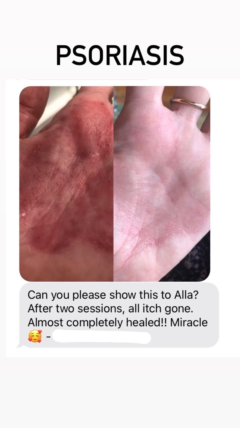  SuJok acupuncture treatment based in Vancouver at Alla Ozerova Acupuncture Clinic used to treat patient with Psoriasis on palms. Red, irritated Psoriasis on hands. 