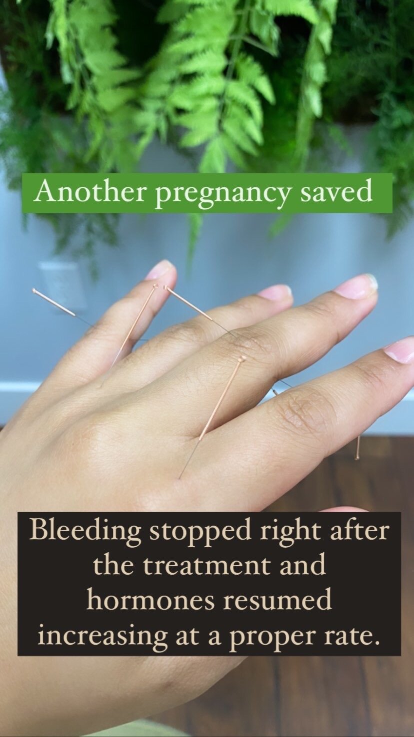  SuJok acupuncture treatment based in Vancouver at Alla Ozerova acupuncture clinic used to treat Fertility. Pregnant patient had bleeding, which stopped after treatment and hormones continued to increase at normal rate.  