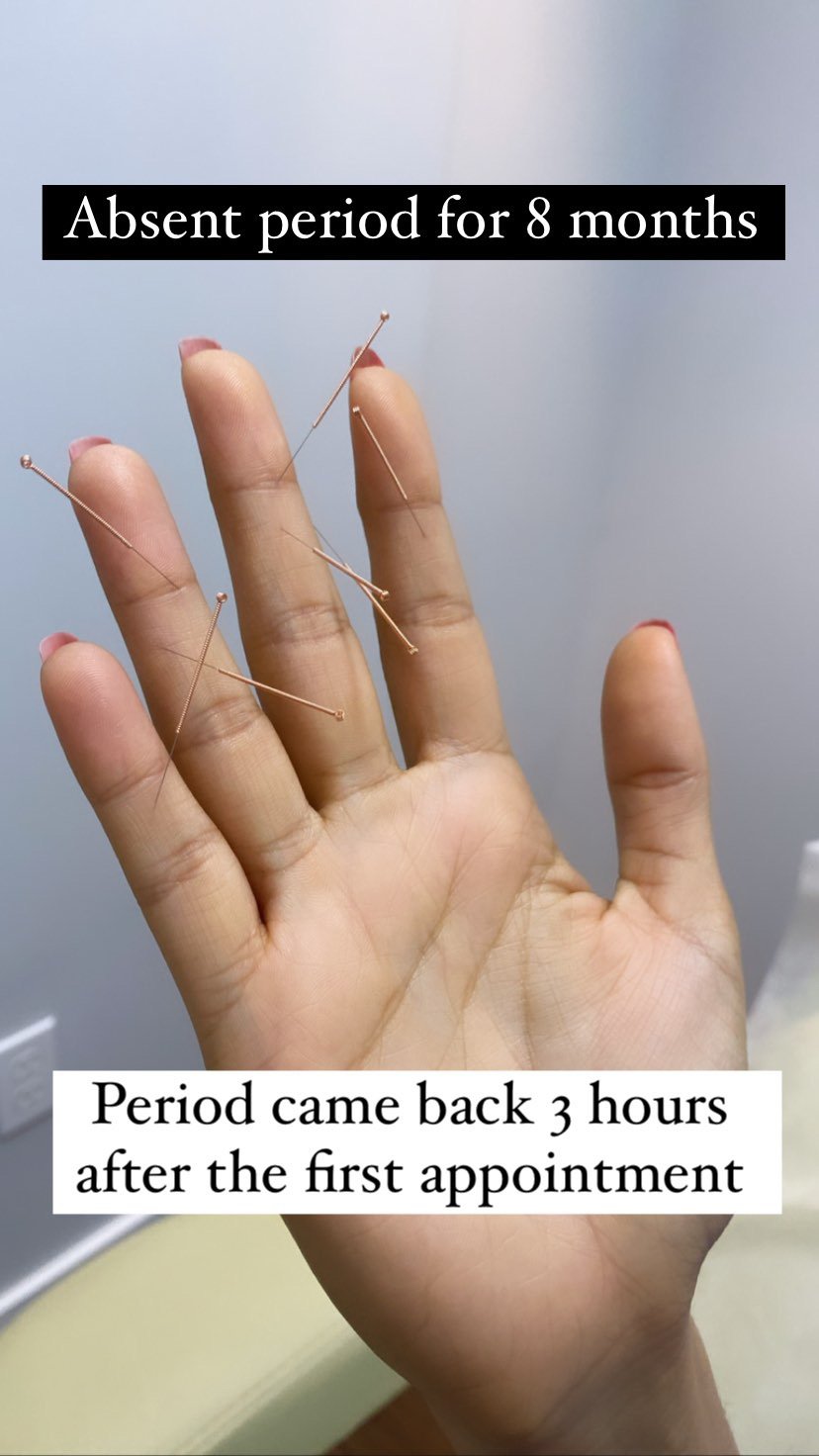  SuJok Acupuncture based in Vancouver at Alla Ozerova Acupuncture Clinic used to treat Reproductive System Conditions. Patient’s period was absent for 8 months. Period came back after 3 hrs after first appointment.  