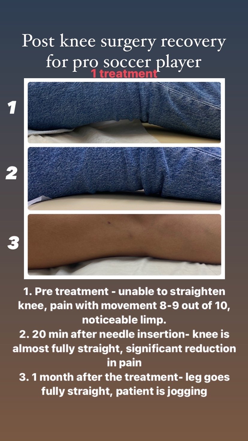  SuJok Acupuncture based in Vancouver at Alla Ozerova Acupuncture Clinic used to treat pain syndrome. Patient treated for post-knee surgery recovery. She was unable to bend knee completely and was finally able to feel less pain and have more mobility