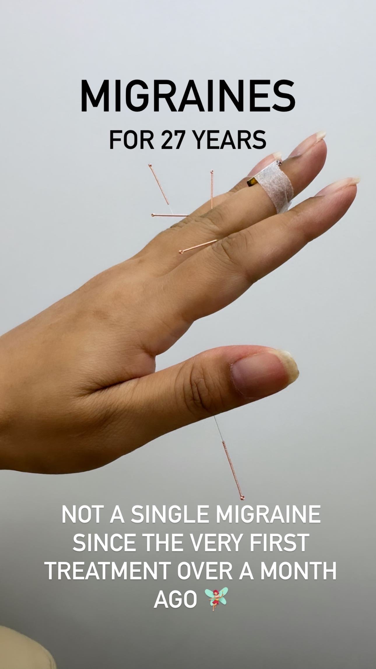  sujok acupuncture treatment at alla ozerova health centre used to treat migraines. Migraine relief. acupuncture for migraines. relief for headaches. natural relief for migraine and headache. how to improve migraines.  