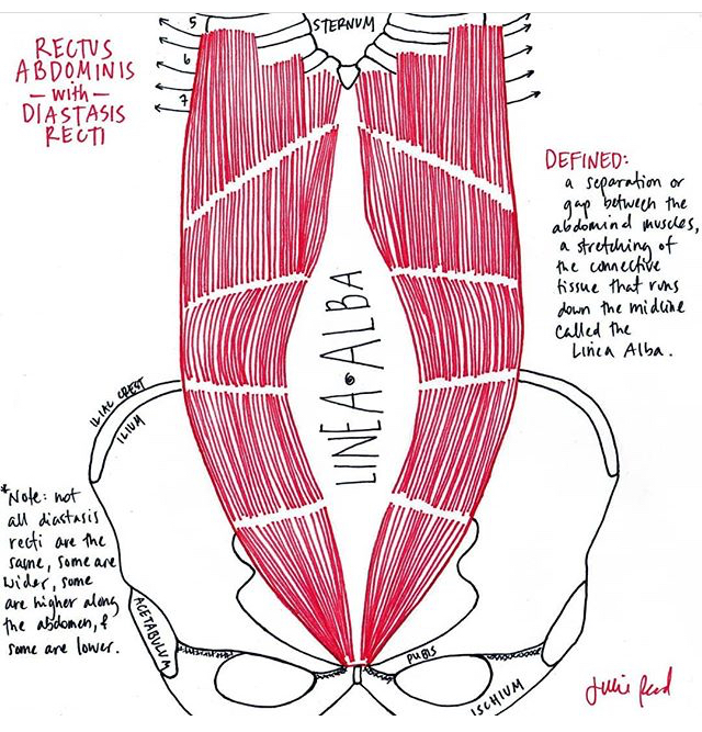Diastasis Recti. The Good, the Bad and the Not So Ugly. — Calgary