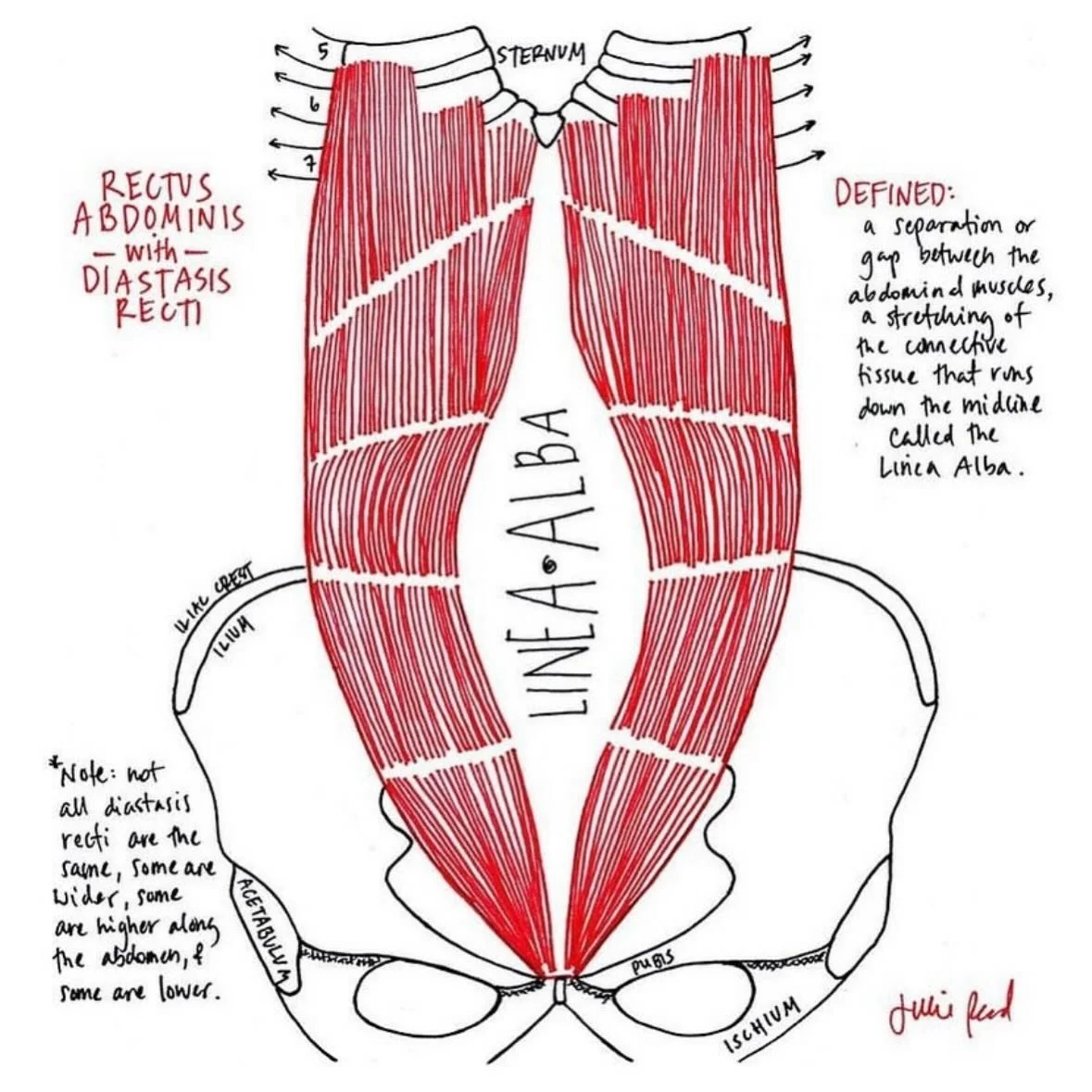 Diastasis Recti. 

We have muscles down the middle of our abdomen, called the Rectus Abdominus Muscles. (sometimes referred to as the 6 pack muscles). In between those muscles, we have connective tissue called Linea Alba. This tissue runs down the mi