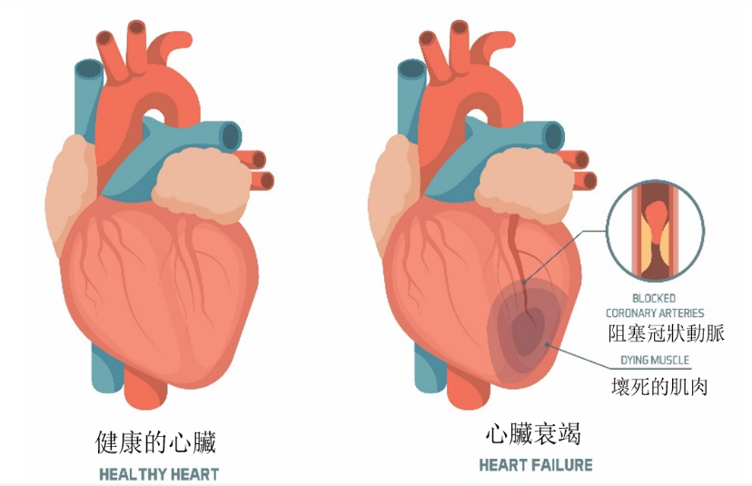 Congestive Heart Failure 心臟衰竭 — AAMG Doctors