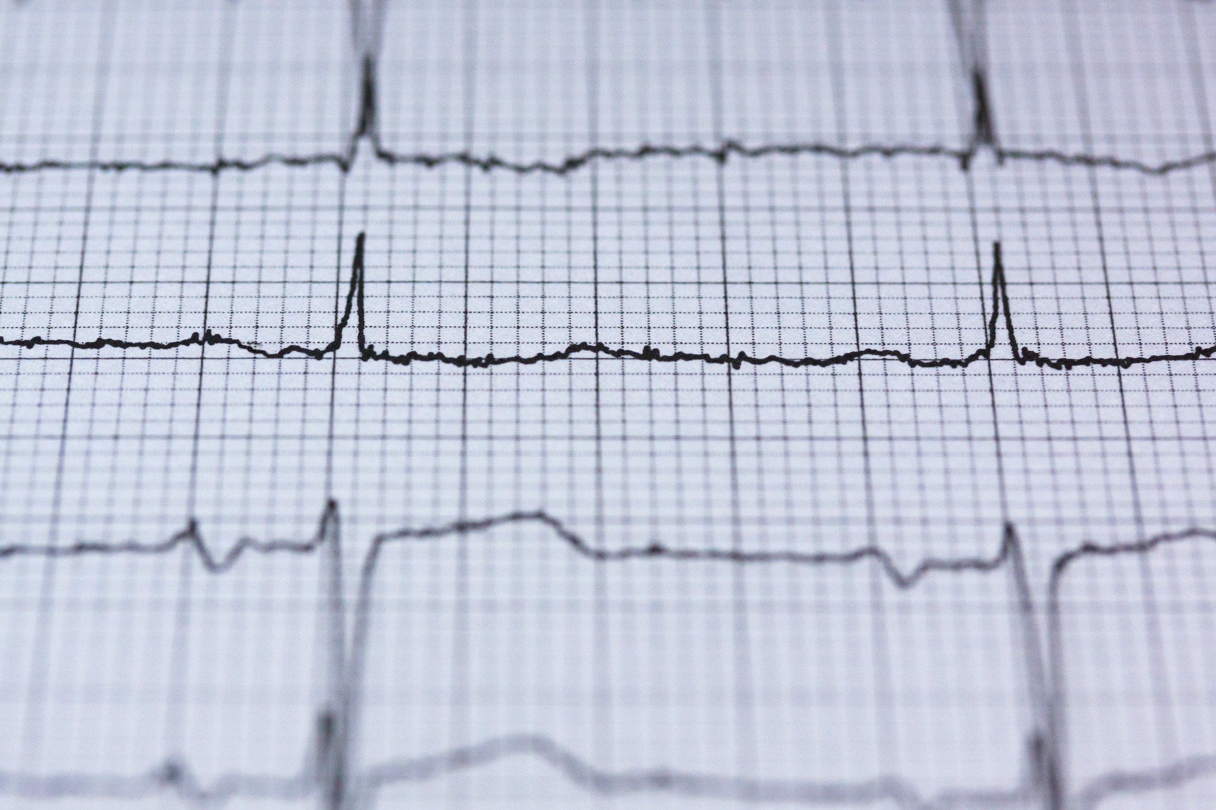 Atrial Fibrillation