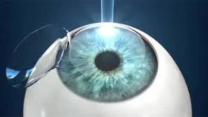 視力回復手術、レーシック体験レポ