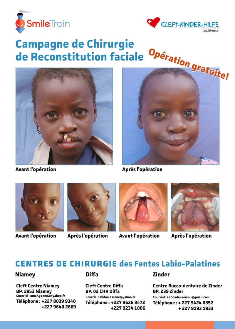 Cleft-Kinder-Hilfe Schweiz Poster.jpg