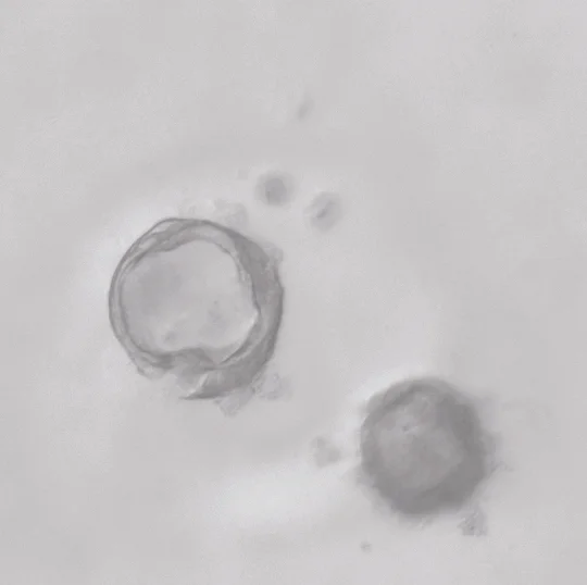 ductal cysts 3.jpg