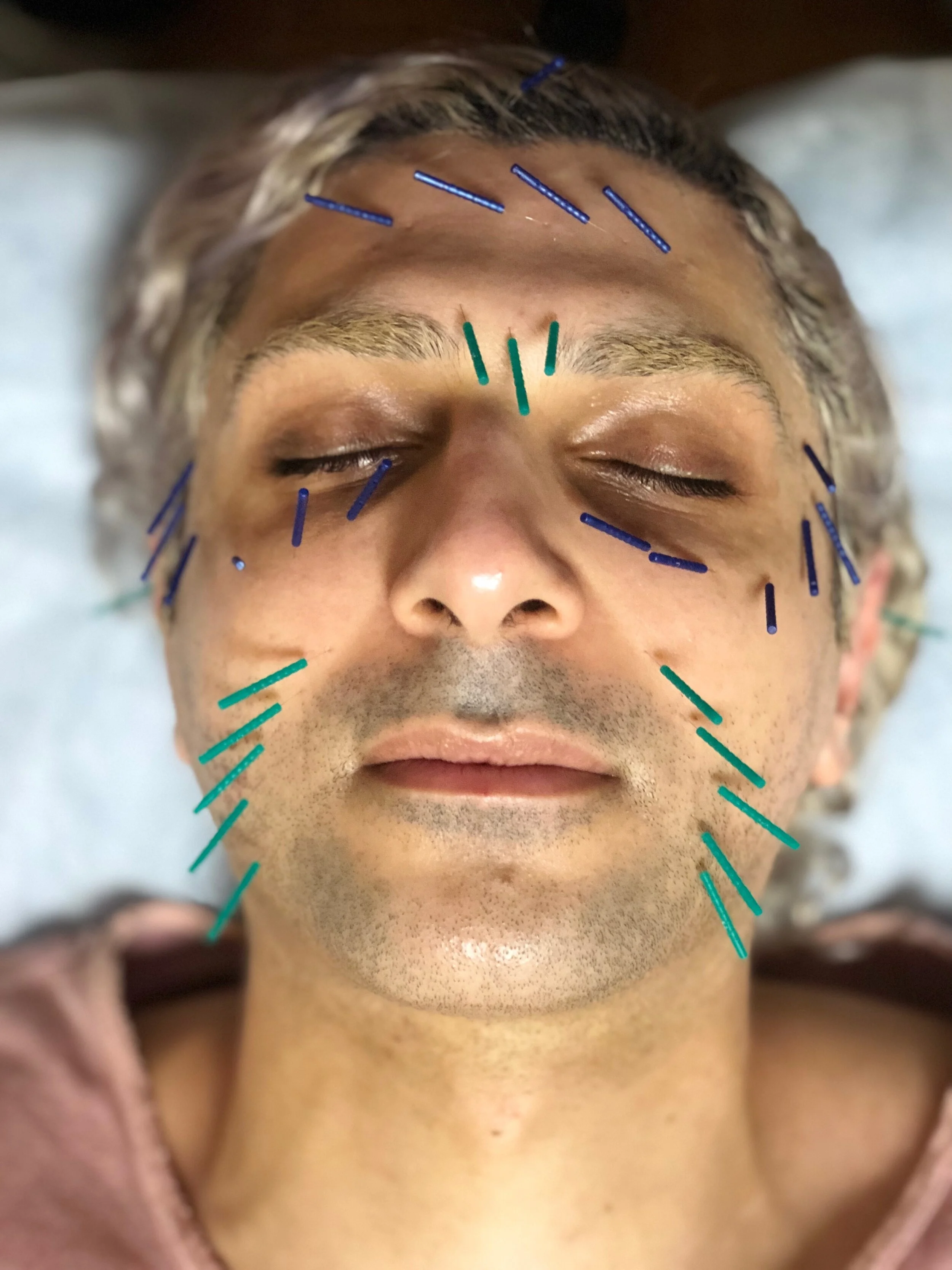 Cosmetic Facial Acupuncture