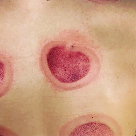 Tomorrow is Valentine&rsquo;s Day! This is a cupping mark made with #lovecupping heart shaped cups. It kind of looks ❤️ shaped. Did you know we&rsquo;re running a special until the end of March 2020 for $20 of your first treatment with us! Call us at