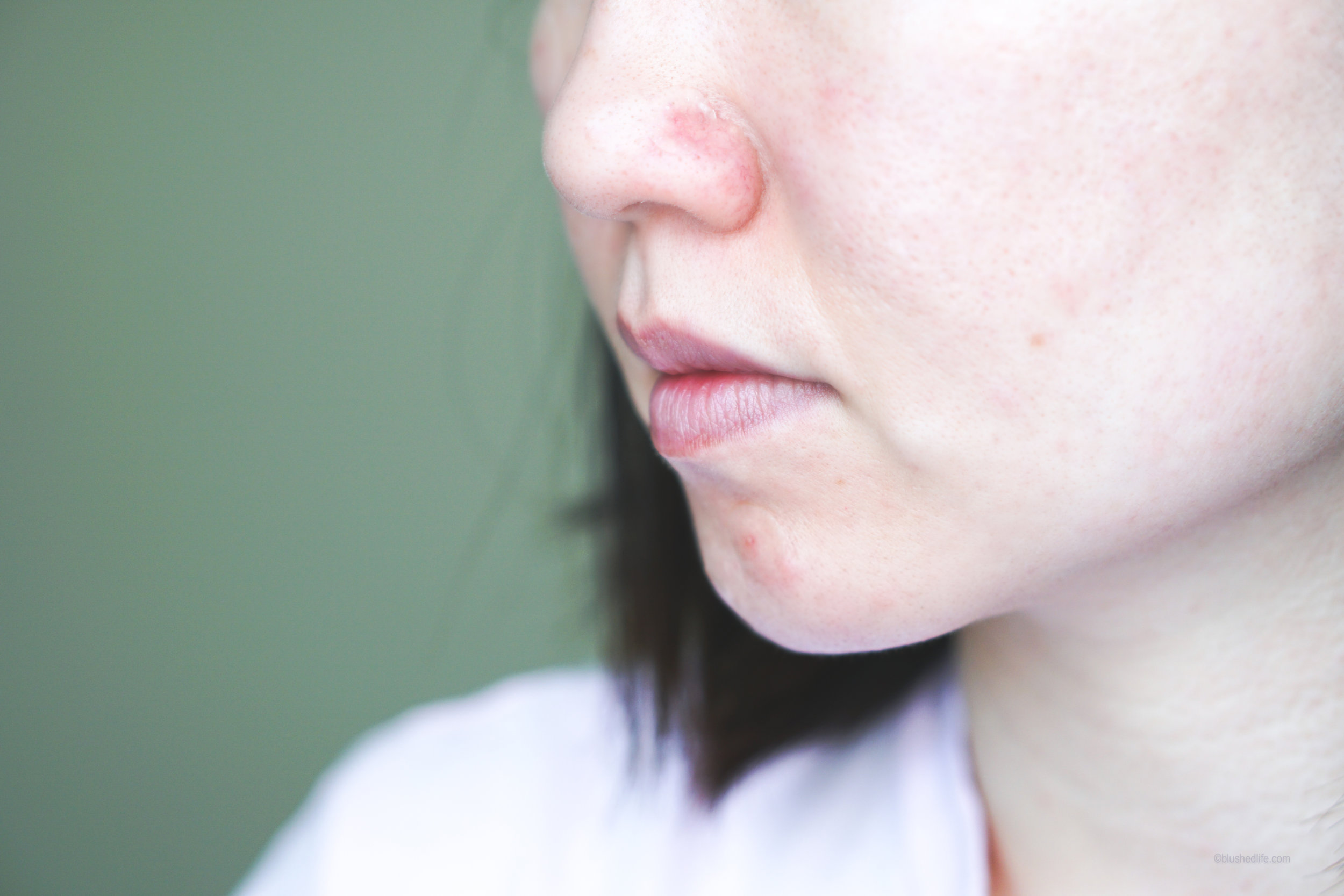 Best Pimple Patches Review Comparison_DSC07278-2.jpg
