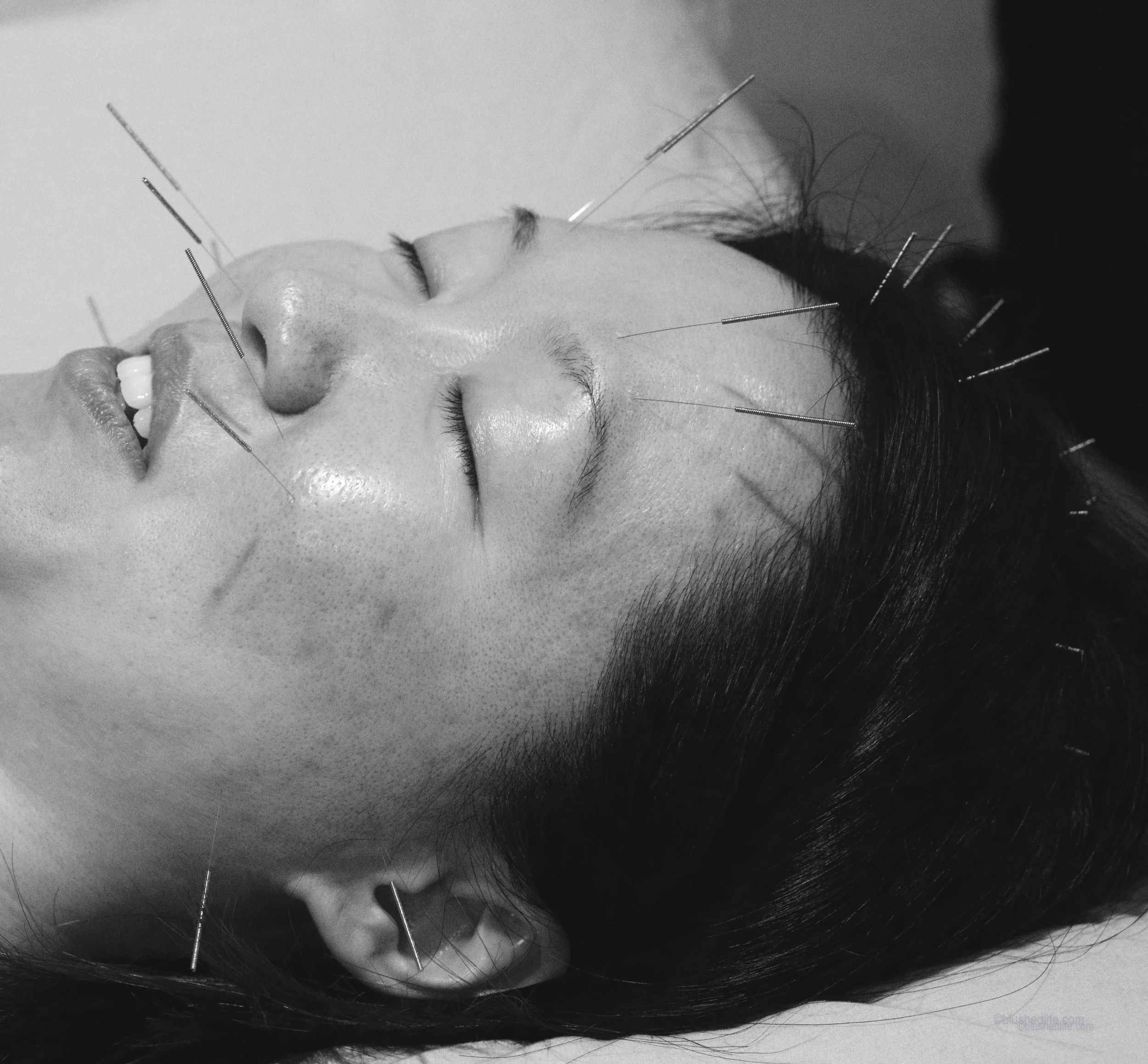 How To Natural Way To Heal Pitted Acne Scars — Valerie Tang