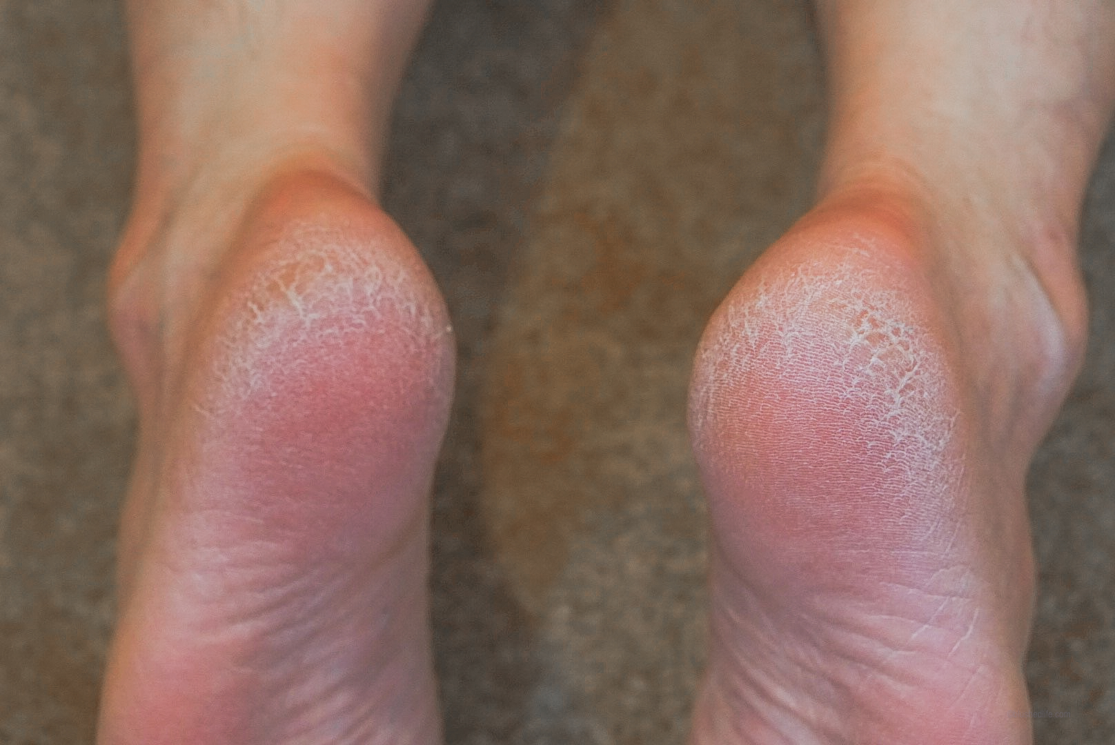 HowToFixDryCrackedFeet_FootPeelingMaskReview_DSC09466-2.jpg