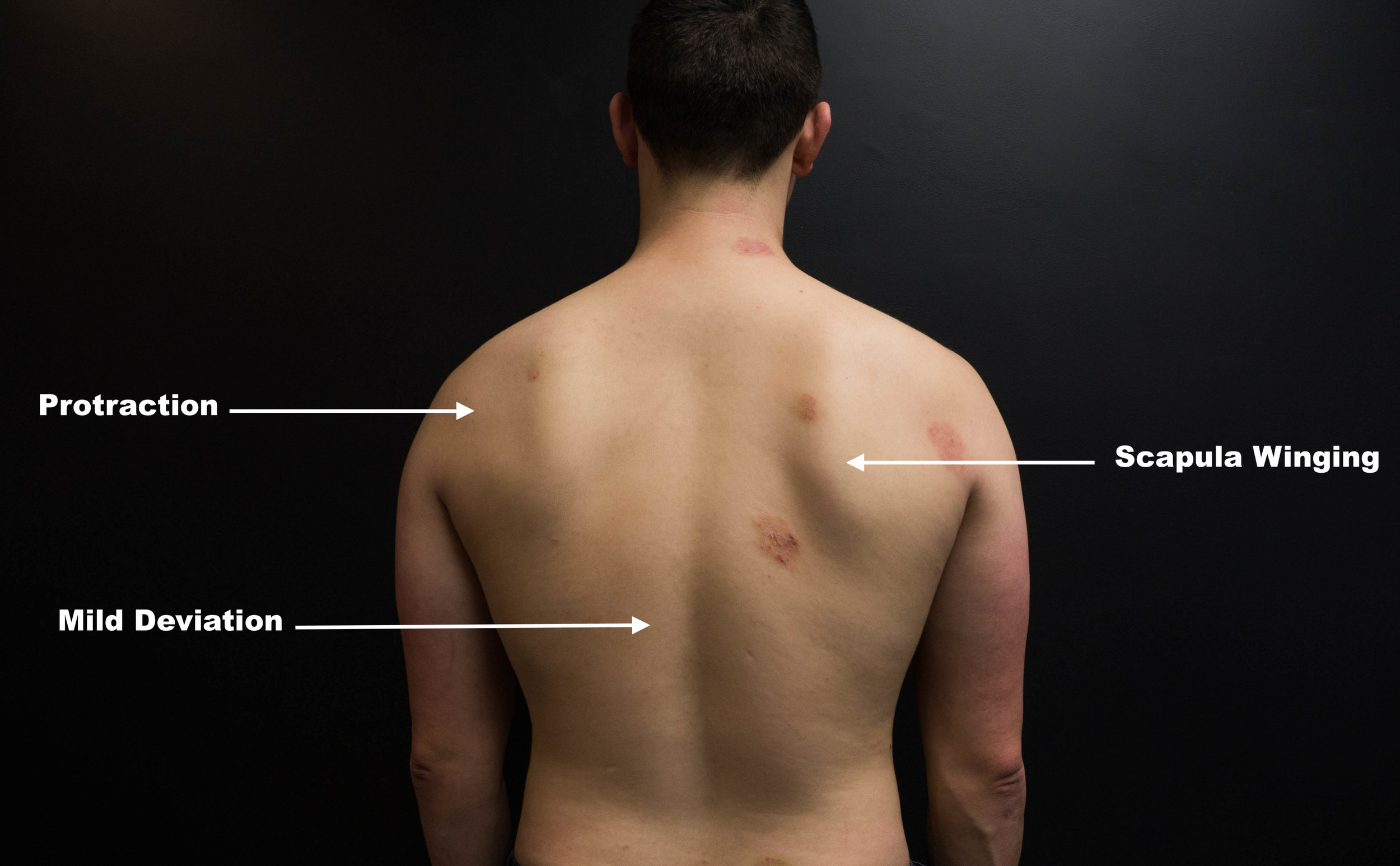 Winged Scapula and Shoulder Pain [Case Study] — ONI | Wellington Personal  Training Studio