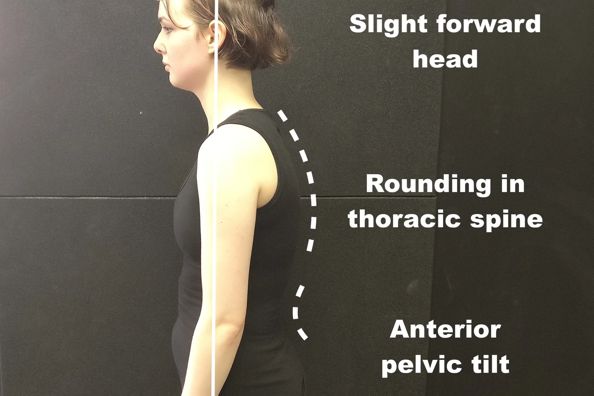 Upper Crossed Syndrome [Case Study - Alec]