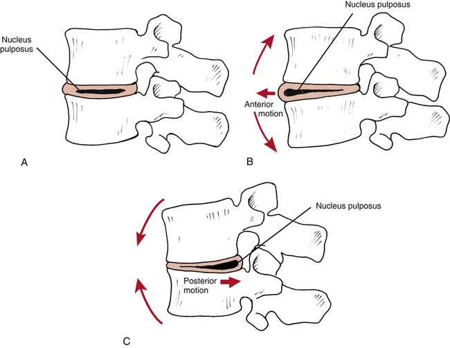 disc-movement.jpg