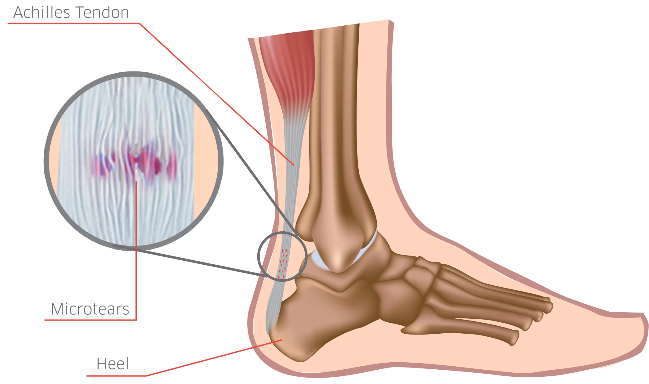 achilles tendon.jpg