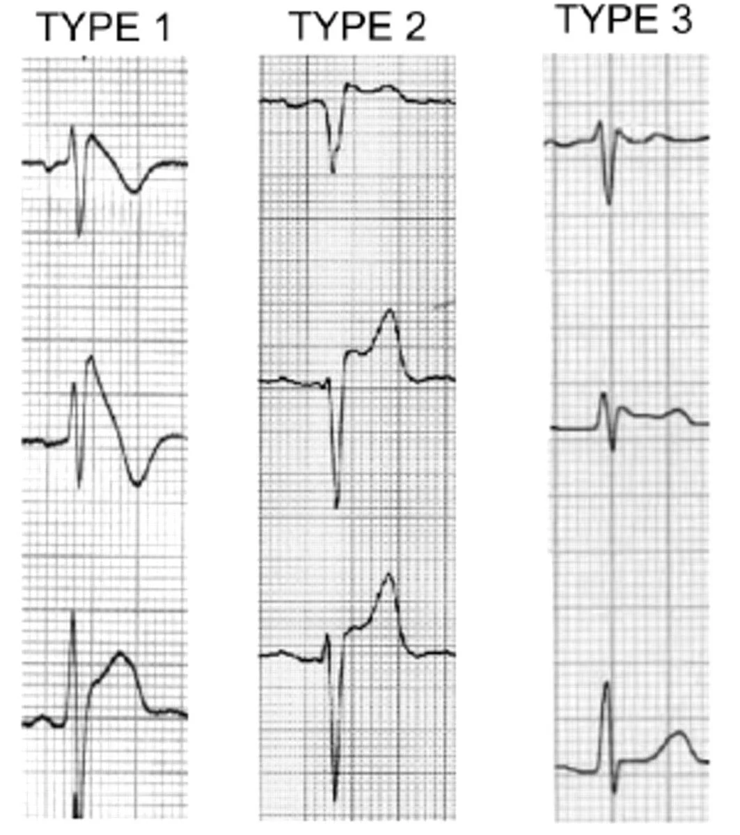 Brugada