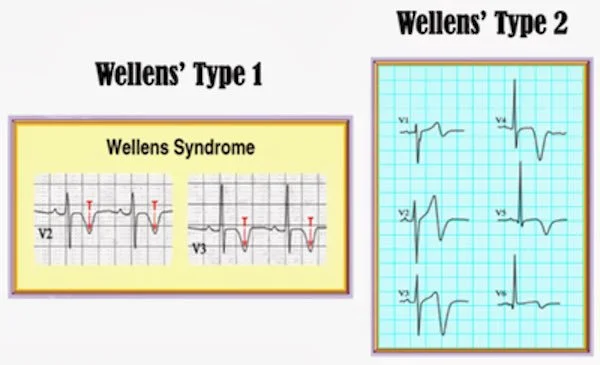 Wellen's
