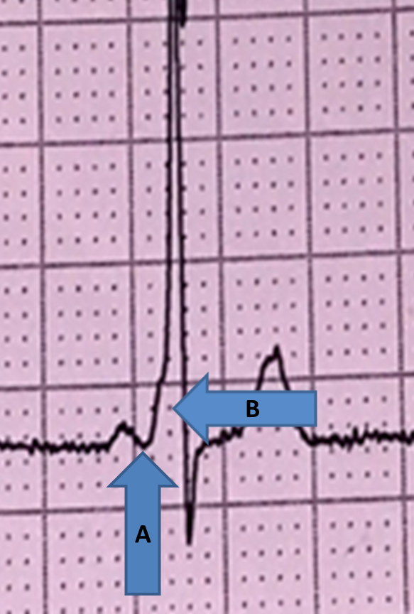 What features are labelled here? What's the diagnosis? (Scroll down for answers)