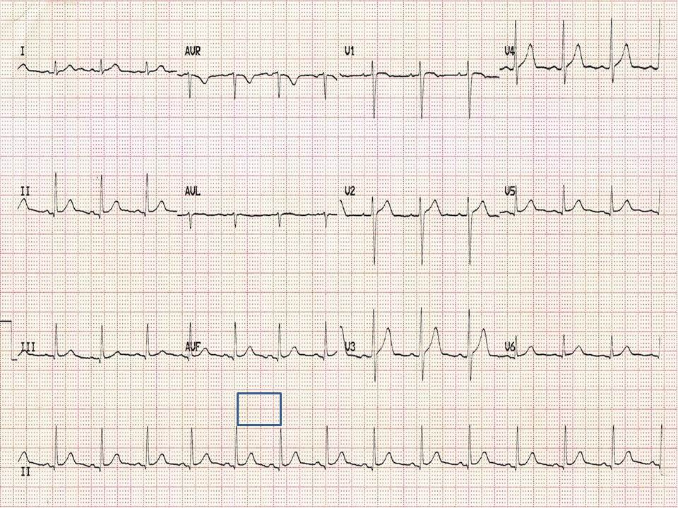 There's about 3.5 big squares between each R wave here. Using 300/3.5 gives a heart rate of 86. Alternatively, there are 15 beats on the rhythm strip, 15 x 6 = 90.