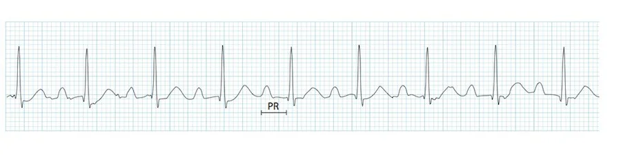 This is benign and often a normal variant 