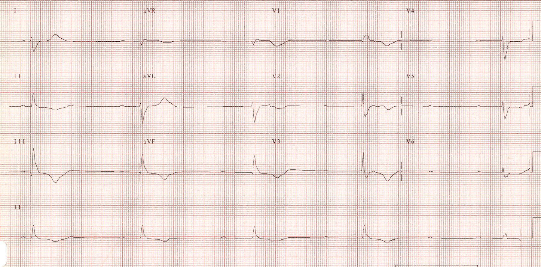 Asystole risk!
