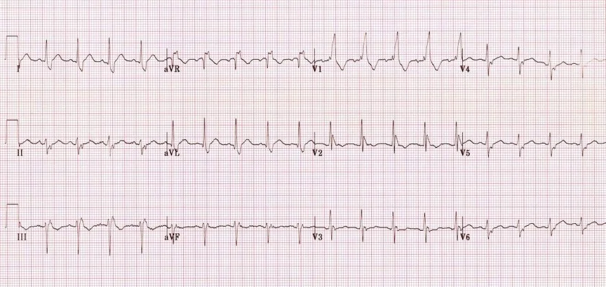 Bifascicular1.jpg