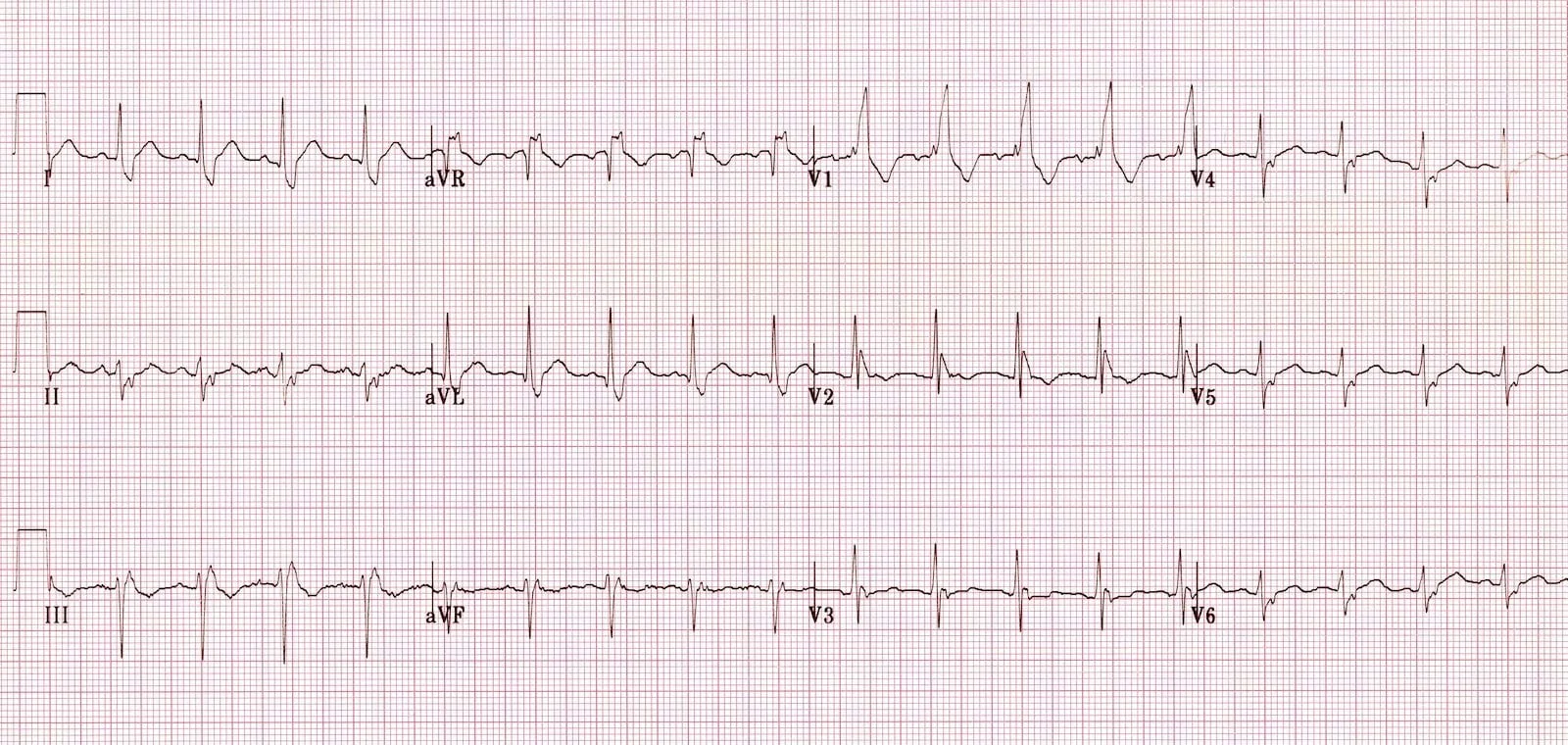 Bifascicular block showing RBBB and LAFB