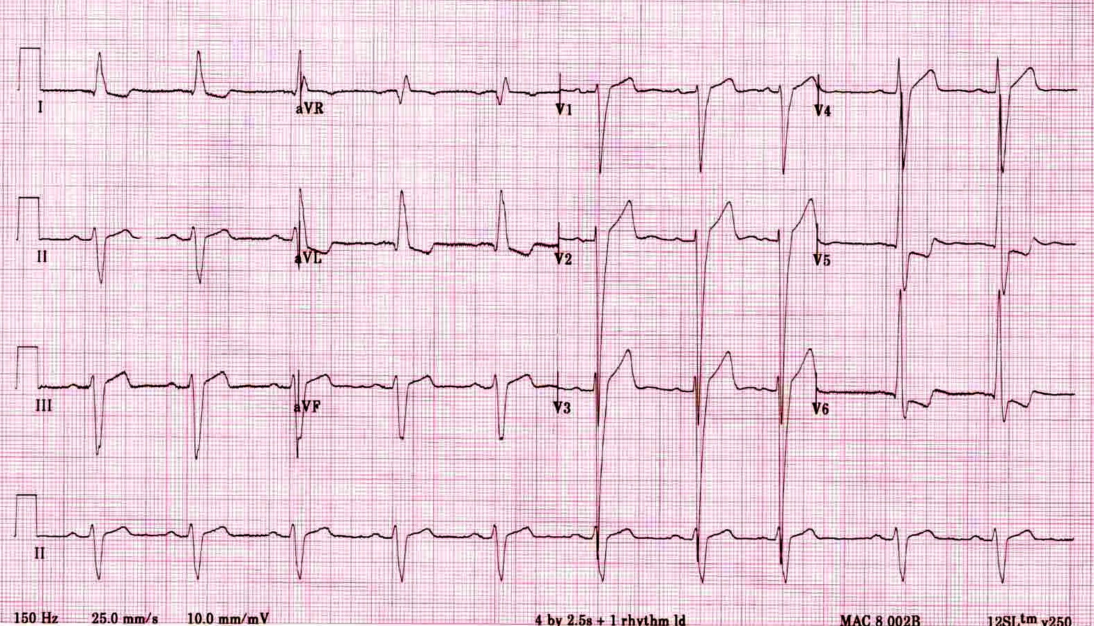 On this ECG you can see the markedly increased LV voltages: huge precordial R and S waves that overlap with the adjacent leads. This is classic for LVH.