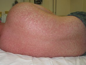 measles08.jpg