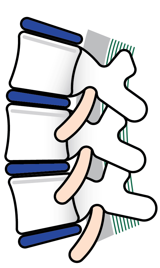 Pinched Nerve