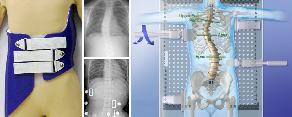 Boston Brace: First Check before X-Ray - Scoliosis and Spine