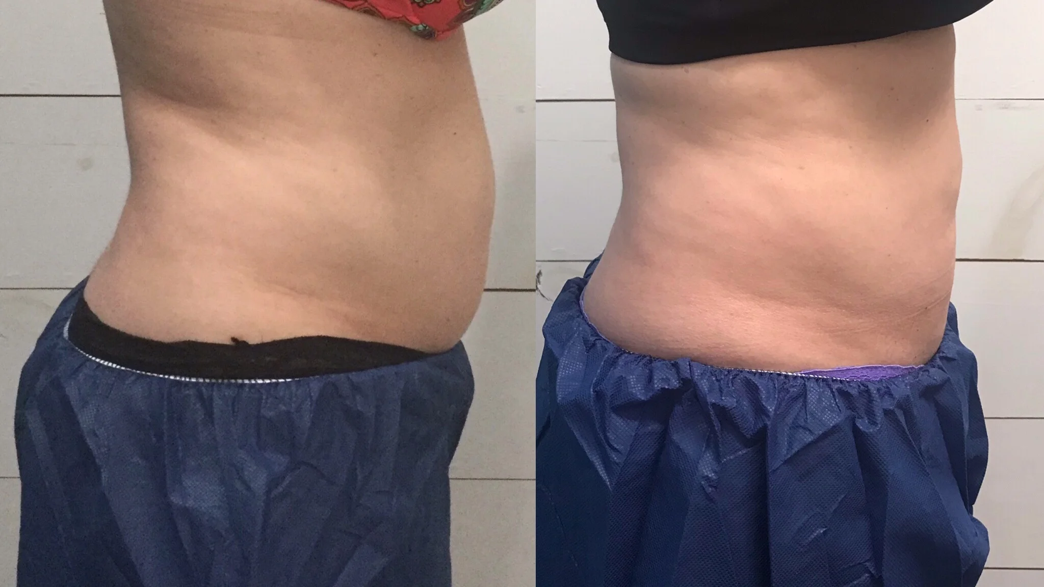12 weeks post 2 treatments truSculpt iD