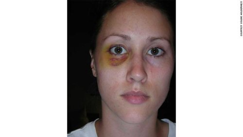Holderness after Porter punched her while on a trip in Italy, photo via CNN
