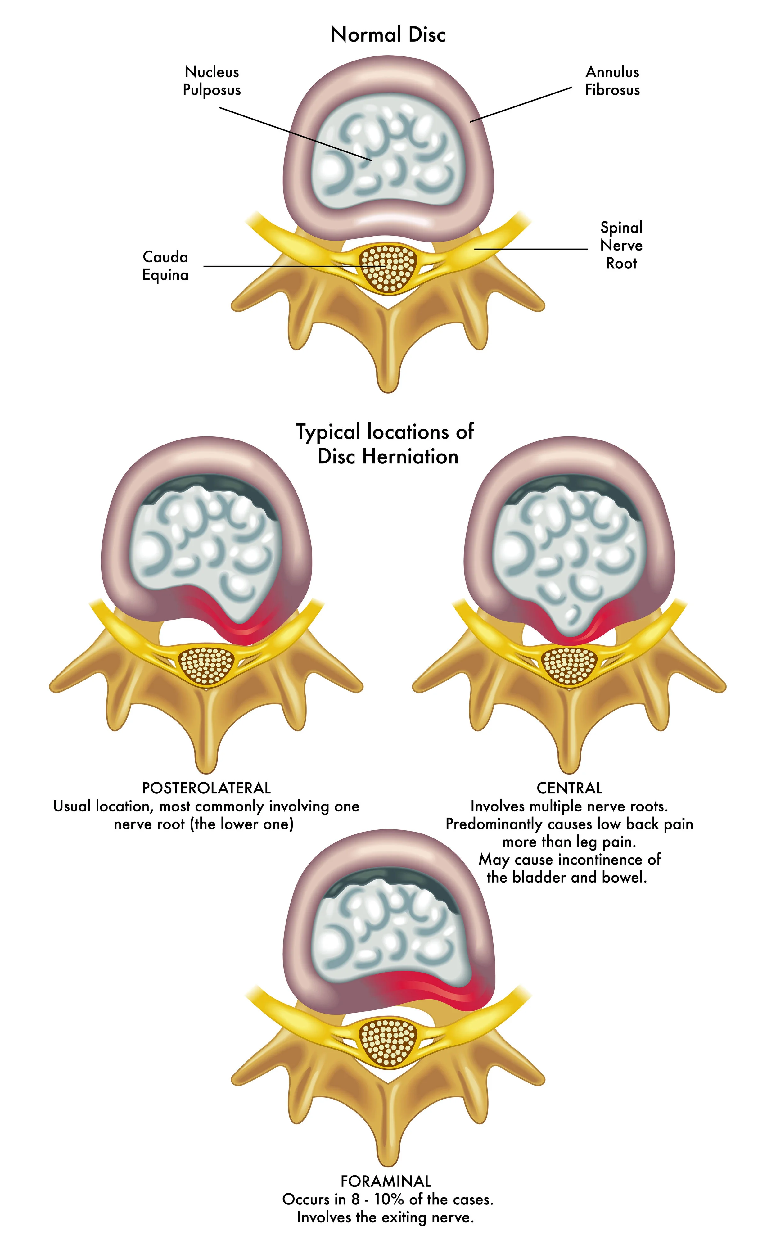 Disc Prolapse & Sciatica, Causes & Treatment