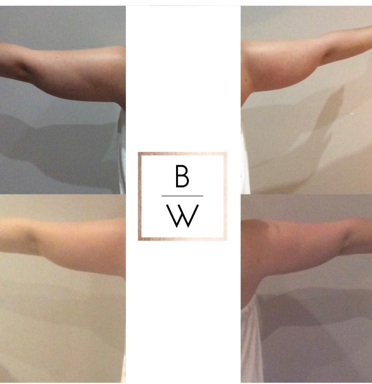Body Contouring — Body Wisdom Perth