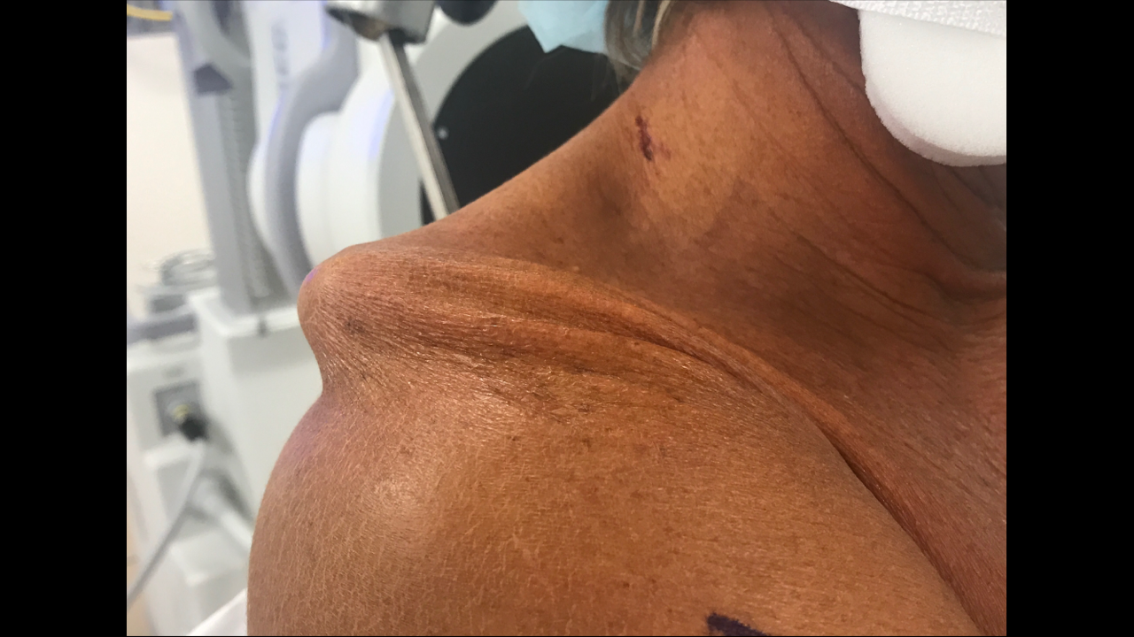 Discipline- Tips on the road to injury recovery 