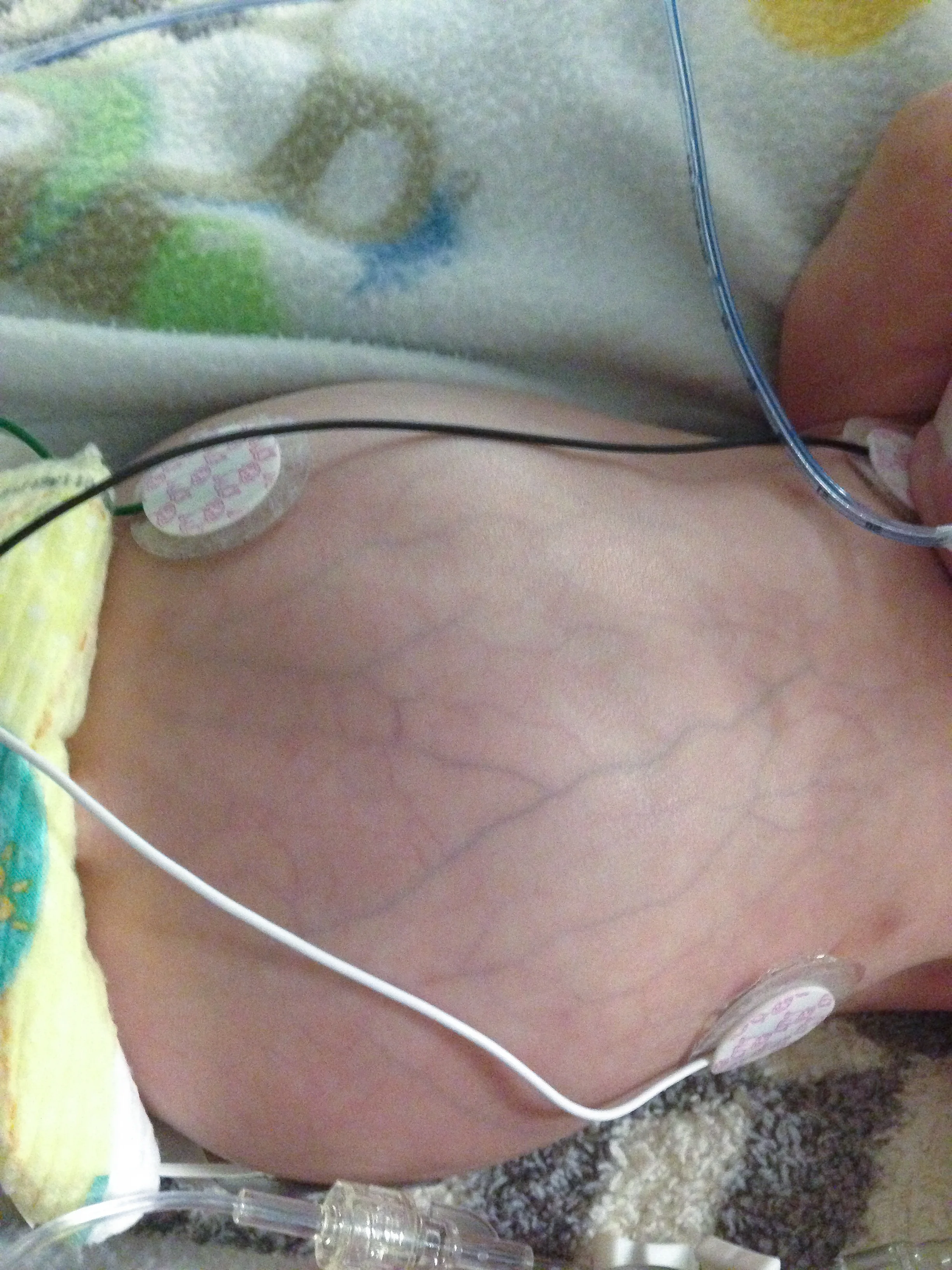 addie belle - diary of a NICU dad - day 79 - shegotguts.com-1-20.jpg