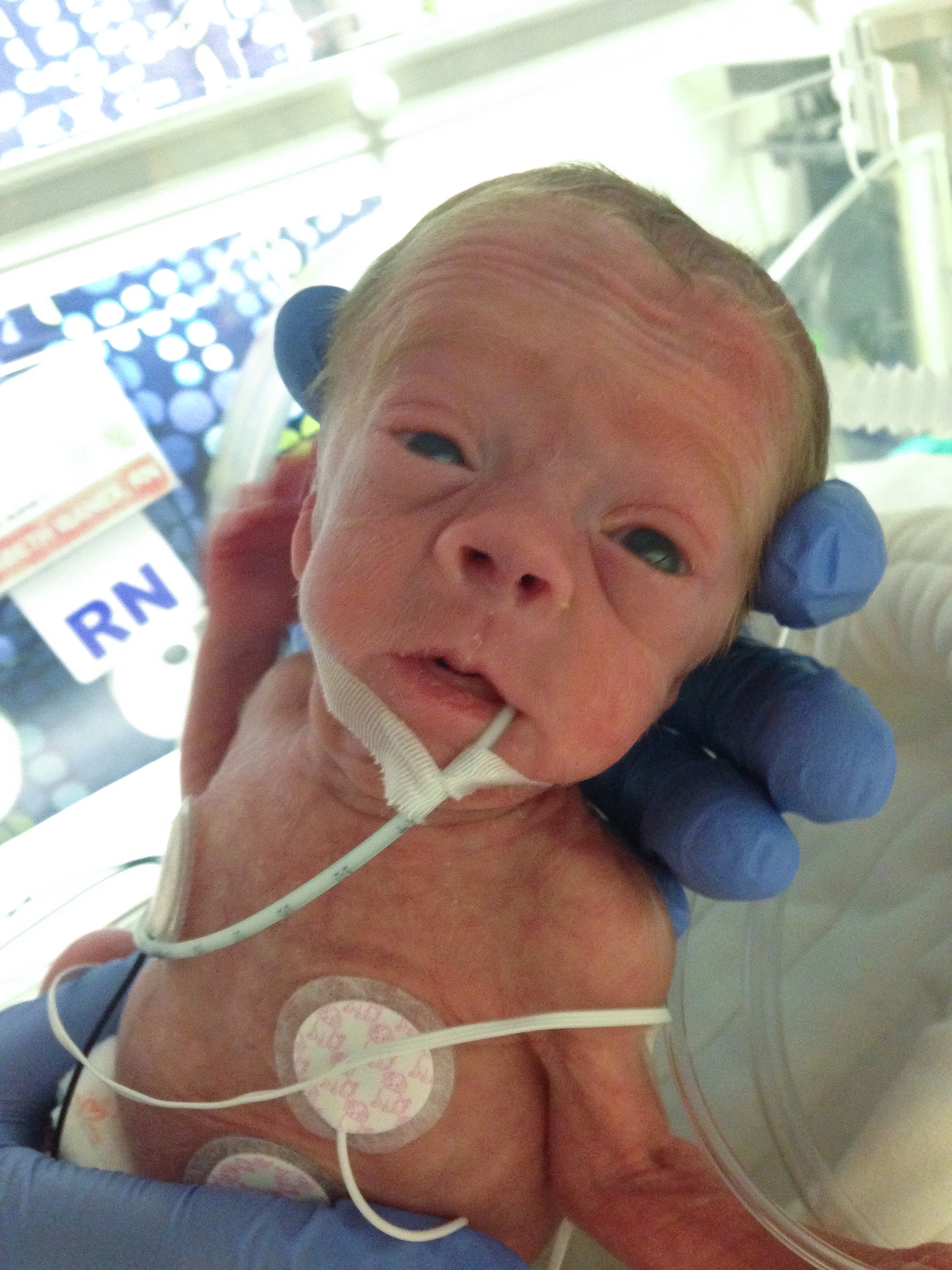 feeding premature babies at home