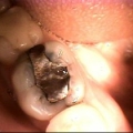 Intra Oral Camera