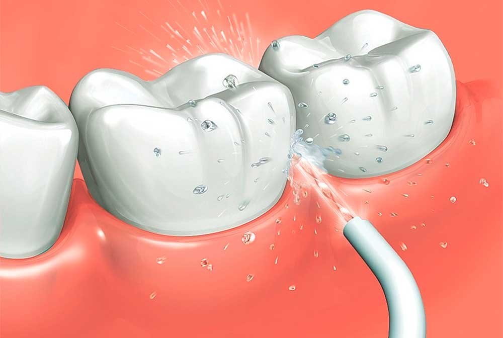 solar traicionar Tratar Irrigador dental: ¿Para qué sirve? — Clínica Dental UCAM