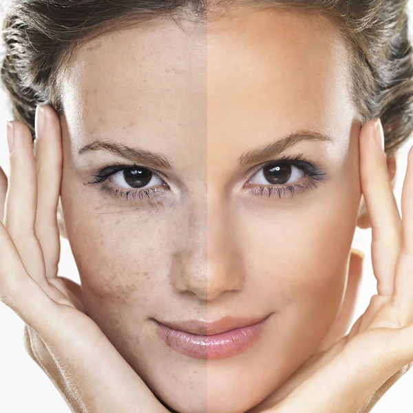 Pigmentation Rejuvenation Treatments: Collagen Induction Therapy - NanoFractional Radio Frequency MicroNeedling Treatment Milk Peel(Glycolic/Salicylic/Lactic) Microdermabrasion & Chemical Peel VI Peel ZO Stimulator Peel ZO 3-Step Peel IPL Photofacial