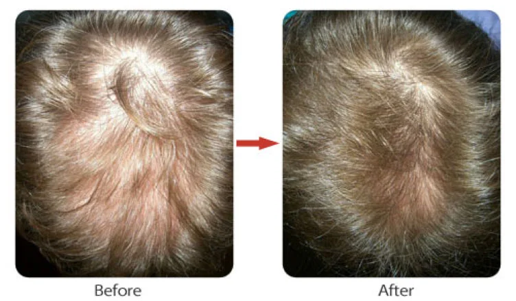Before and after of Laser Cap use