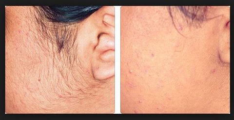 Fast, effective, permanent -Laser Hair Removal