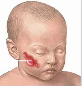 Mã số N2016: Bệnh viện Nhi đồng 1 điều trị thành công bướu máu cho trẻ dưới 12 tháng tuổi bằng Timolol