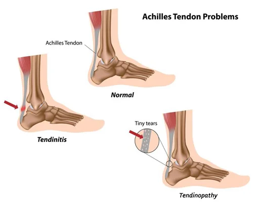 124273737-1plantar-fasciitis-3d-medical-vector-illustration-on-white-background_500x403px.jpg