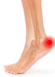 Achilles Tendinopathy.jpeg